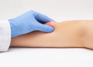 Lipoma diagnosis